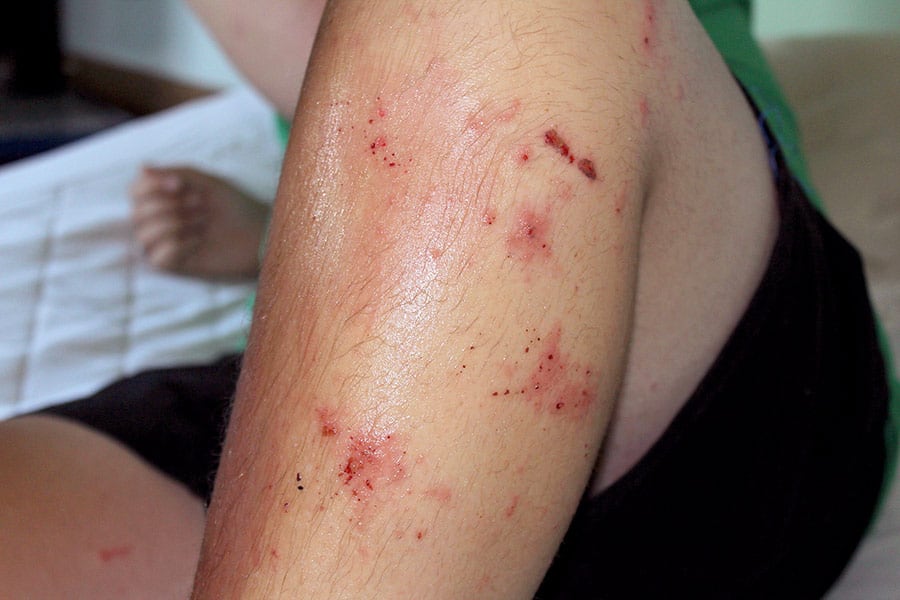 Poison Ivy rash on man's leg